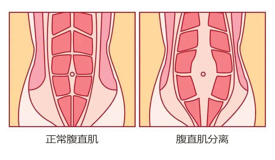 漏尿、松弛、肚子大星空体育app平台……别再忍！这个修复方法在家就能做(图6)