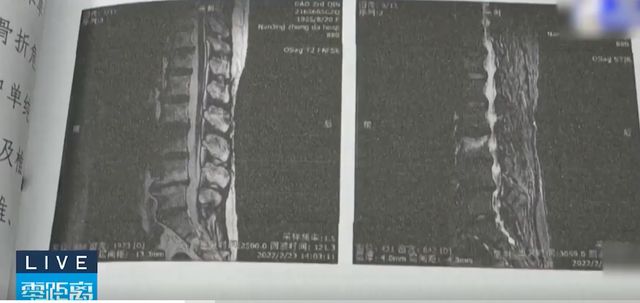 7旬老人花8万元练普拉提导致星空体育app平台腰椎骨折法院：健身房存在过错(图2)